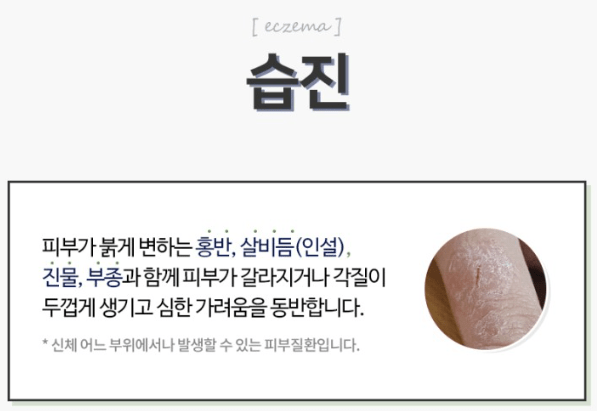 겨울철에 건조해지면 차자오는 고질병 "습진" 습진에 대해~!