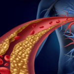이상지질혈증, 당신의 혈관을 위협하는 적
