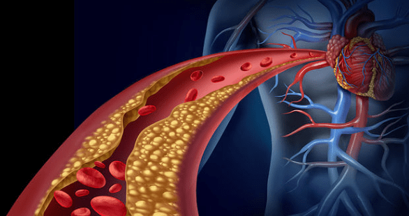 이상지질혈증, 당신의 혈관을 위협하는 적
