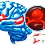 뇌동맥류,머리 속 시한폭탄! 뇌동맥류 알아보기