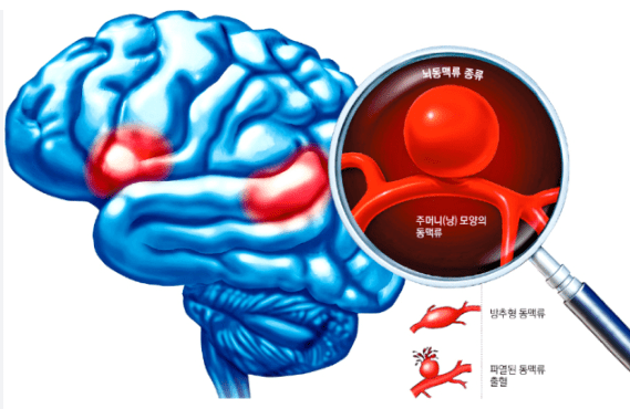 뇌동맥류,머리 속 시한폭탄! 뇌동맥류 알아보기