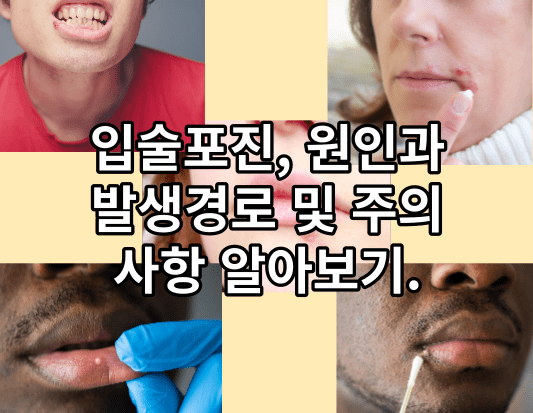 입술포진, 원인과 발생경로 및 주의사항 알아보기.