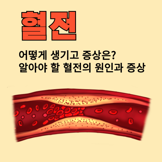 혈전, 어떻게 생기고 증상은? 알아야 할 혈전의 원인과 증상