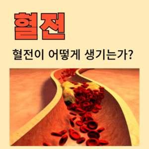 혈전, 어떻게 생기고 증상은? 알아야 할 혈전의 원인과 증상