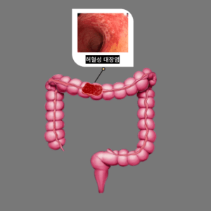 허혈성 대장염: 갑작스러운 복통, 혈변, 설사는 무엇을 의미할까?